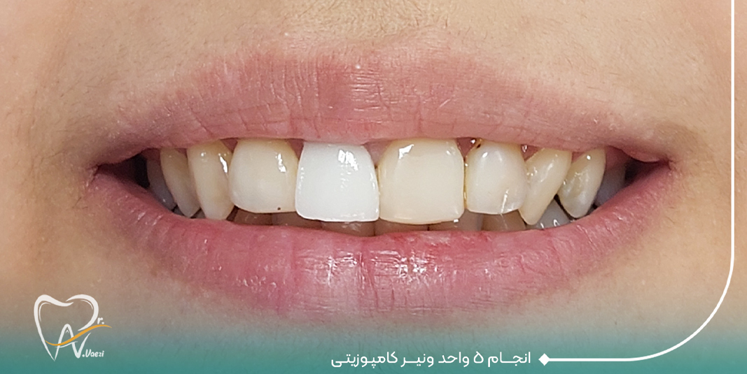 ونیر کامپوزیتی دندان تبریز دندانپزشکی زیبایی تبریز کامپوزیت دندان در تبریز قیمت کامپوزیت دندان در تبریزبهترین دکتر کامپوزیت دندان در تبریز دکتر نگین واعظی