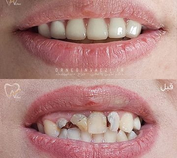نمونه کار اصلاح لبخند در تبریز با روکش های دندانی توسط دکتر نگین واعی در ولیعصر تبریز