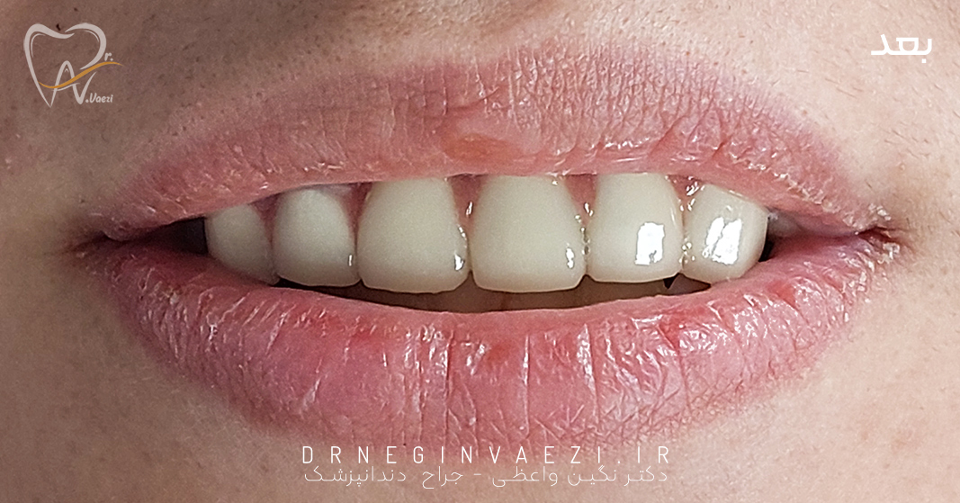 اصلاح لبخند در تبریز روکش دندان در تبریز روکش دندان های جلو در تبریز روش سرامیکی دندان در تبریز دکتر نگین واعظی در تبریز