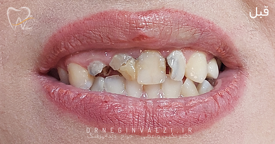 اصلاح لبخند در تبریز روکش دندان در تبریز روکش دندان های جلو در تبریز روش سرامیکی دندان در تبریز دکتر نگین واعظی در تبریز