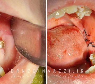 جراحی دندان عقل نهفته توسط دکتر نگین واعظی جراحی دندان عقل در تبریز جراحی دندان در خوی بهترین جراح دندان عقل نهفته در تبریز