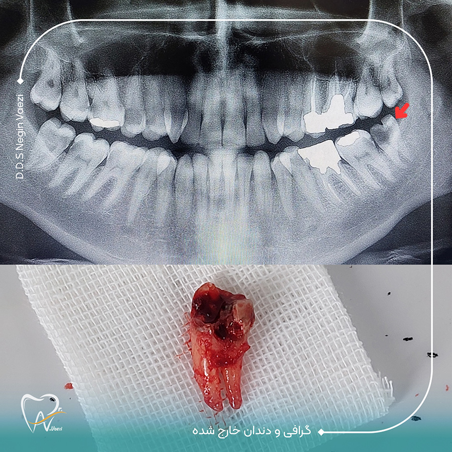 قیمت جراحی دندان عقل نهفته در تبریز دکتر خوب برای دندان عقل در تبریز دکتر خانم برای جراحی دندان عقل در تبریز کشیدن دندان در تبریز قیمت جراحی دندان عقل در تبریز