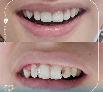 درمان ریشه دندان تبریز ترمیم کامپوزیت دندان تبریز دندانپزشکی نوجوانان تبریز عصب‌کشی دندان در تبریز بهترین دندانپزشک تبریز متخصص درمان ریشه در تبریز ترمیم دندان نوجوانان تبریز دندانپزشک کودکان و نوجوانان تبریز خدمات دندانپزشکی در تبریز دندانپزشک خوب در تبریز درمان دندان درد تبریز کلینیک دندانپزشکی تبریز هزینه درمان ریشه در تبریز