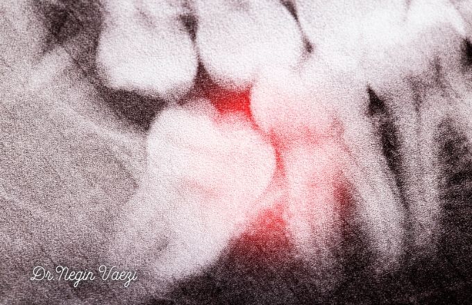 جراحی دندان عقل در تبریز جراحی دندان عقل نهفته در تبریز متخصص جراحی دندان عقل تبریز کلینیک جراحی دندان عقل تبریز قیمت جراحی دندان عقل در تبریز بهترین جراح دندان عقل تبریز عوارض جراحی دندان عقل در تبریز جراحی دندان عقل بدون درد در تبریز کشیدن دندان عقل نهفته تبریز دندانپزشکی جراحی عقل تبریز