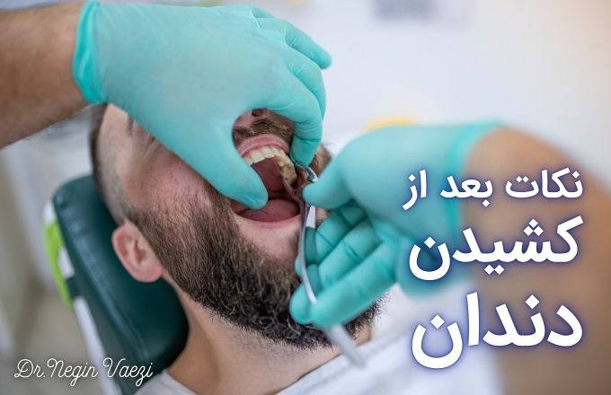 مراقبت‌های بعد از کشیدن دندان کشیدن دندان در تبریز بهترین دندانپزشک تبریز مراقبت دهان بعد از کشیدن دندان درد بعد از کشیدن دندان ورم بعد از کشیدن دندان عفونت بعد از کشیدن دندان خونریزی بعد از کشیدن دندان کشیدن دندان عقل در تبریز رعایت بهداشت دهان بعد از کشیدن دندان زمان بهبودی بعد از کشیدن دندان غذاهای مناسب بعد از کشیدن دندان پیشگیری از خشکی ساکت دندان خدمات دندانپزشکی در تبریز هزینه کشیدن دندان در تبریز