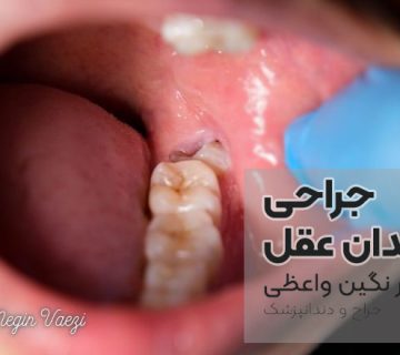جراحی دندان عقل در تبریز جراحی دندان عقل نهفته در تبریز متخصص جراحی دندان عقل تبریز کلینیک جراحی دندان عقل تبریز قیمت جراحی دندان عقل در تبریز بهترین جراح دندان عقل تبریز عوارض جراحی دندان عقل در تبریز جراحی دندان عقل بدون درد در تبریز کشیدن دندان عقل نهفته تبریز دندانپزشکی جراحی عقل تبریز