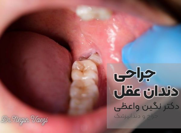 جراحی دندان عقل در تبریز جراحی دندان عقل نهفته در تبریز متخصص جراحی دندان عقل تبریز کلینیک جراحی دندان عقل تبریز قیمت جراحی دندان عقل در تبریز بهترین جراح دندان عقل تبریز عوارض جراحی دندان عقل در تبریز جراحی دندان عقل بدون درد در تبریز کشیدن دندان عقل نهفته تبریز دندانپزشکی جراحی عقل تبریز