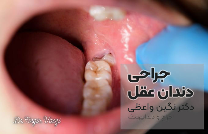 جراحی دندان عقل در تبریز جراحی دندان عقل نهفته در تبریز متخصص جراحی دندان عقل تبریز کلینیک جراحی دندان عقل تبریز قیمت جراحی دندان عقل در تبریز بهترین جراح دندان عقل تبریز عوارض جراحی دندان عقل در تبریز جراحی دندان عقل بدون درد در تبریز کشیدن دندان عقل نهفته تبریز دندانپزشکی جراحی عقل تبریز