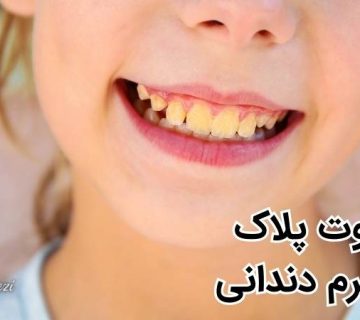 جرم دندان چیست - پلاک دندانی چیست - جرم گیری دندان در تبریز - دکتر نگین واعظی