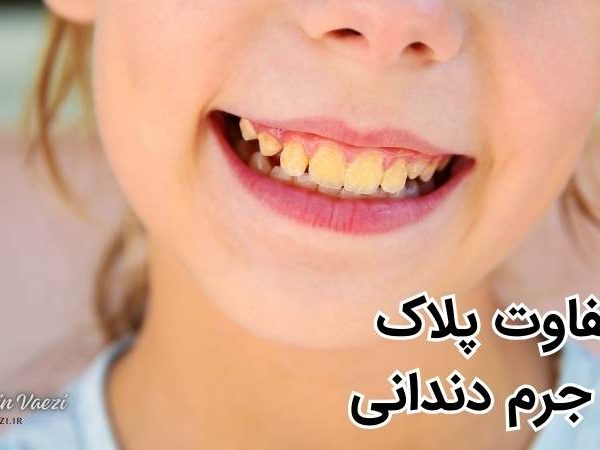 جرم دندان چیست - پلاک دندانی چیست - جرم گیری دندان در تبریز - دکتر نگین واعظی