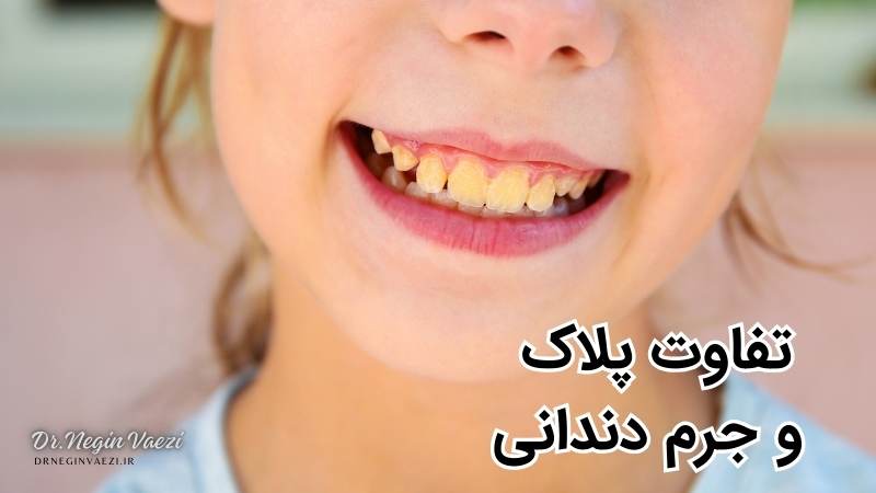 جرم دندان چیست - پلاک دندانی چیست - جرم گیری دندان در تبریز - دکتر نگین واعظی