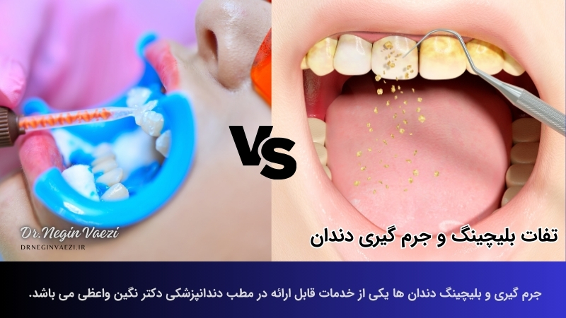 بلیچینگ در تبریز جرم گیری در تبریز بهترین مطب بلیچینگ در تبریز بهترین مطب جرم گیری در تبریز دکتر نگین واعظی دندانپزشک
