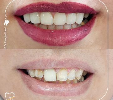 ونیر کامپوزیت دندان زیبایی دندان با کامپوزیت لبخند جذاب با ونیر اصلاح دندان با ونیر کامپوزیت درمان زیبایی دندان‌ها لبخند هالیوودی با ونیر کامپوزیت ونیر طبیعی بهبود ظاهر دندان‌ها لبخند بی‌نقص با ونیر کامپوزیت ماندگاری بالا ونیر کامپوزیت