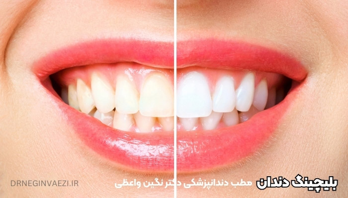 بلیچینگ دندان در تبریز   عوامل موثر در سفید کردن دندان ها