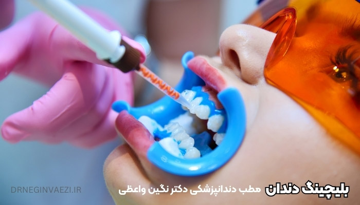 بلیچینگ دندان در تبریز هزینه بلیچینگ دندان در تبریز دکتر دندانپزشک خانم برای سفید کردن دندان در تبریز ولیعصر بلیچینگ ارزان در تبریز