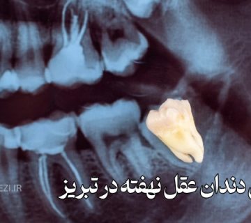 جراحی دندان عقل نهفته در تبریز دندانپزشک متخصص جراحی دندان عقل در تبریز هزینه جراحی دندان عقل در تبریز بهترین دندانپزشک جراحی دندان عقل تبریز