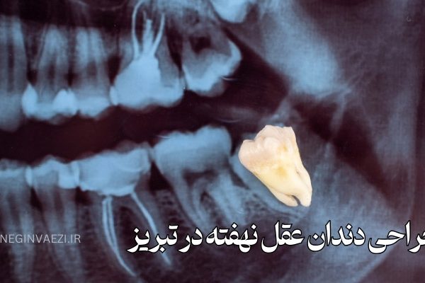 جراحی دندان عقل نهفته در تبریز دندانپزشک متخصص جراحی دندان عقل در تبریز هزینه جراحی دندان عقل در تبریز بهترین دندانپزشک جراحی دندان عقل تبریز