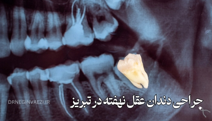 جراحی دندان عقل نهفته در تبریز دندانپزشک متخصص جراحی دندان عقل در تبریز هزینه جراحی دندان عقل در تبریز بهترین دندانپزشک جراحی دندان عقل تبریز