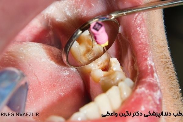 عصب کشی دندان در تبریز درمان ریشه در تبریز بهترین دندانپزشک عصب کشی در تبریز قیمت عصب کشی دندان دکتر خانم برای عصب کشی دندان