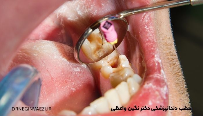عصب کشی دندان در تبریز درمان ریشه در تبریز بهترین دندانپزشک عصب کشی در تبریز قیمت عصب کشی دندان دکتر خانم برای عصب کشی دندان