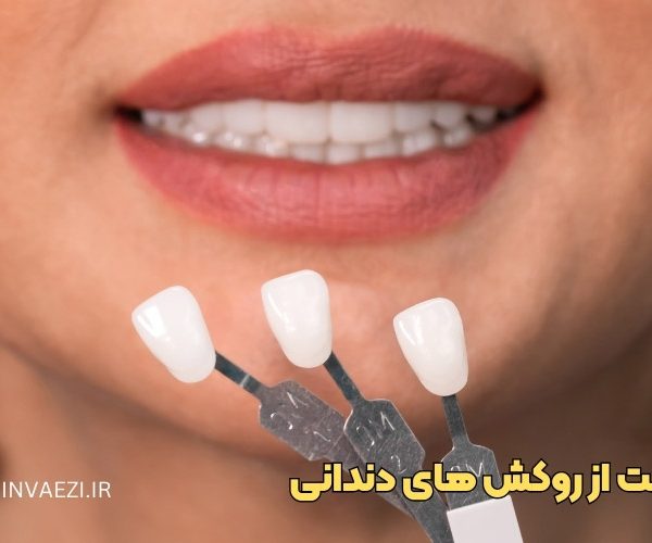 روکش دندان، مراقبت از روکش دندان، روش تمیز کردن روکش، انواع روکش دندان، هزینه روکش دندان، نخ دندان مخصوص روکش، ماندگاری روکش دندان، دلایل لق شدن روکش دندانی