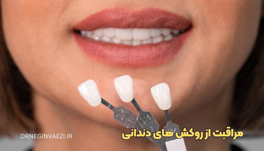 روکش دندان، مراقبت از روکش دندان، روش تمیز کردن روکش، انواع روکش دندان، هزینه روکش دندان، نخ دندان مخصوص روکش، ماندگاری روکش دندان، دلایل لق شدن روکش دندانی