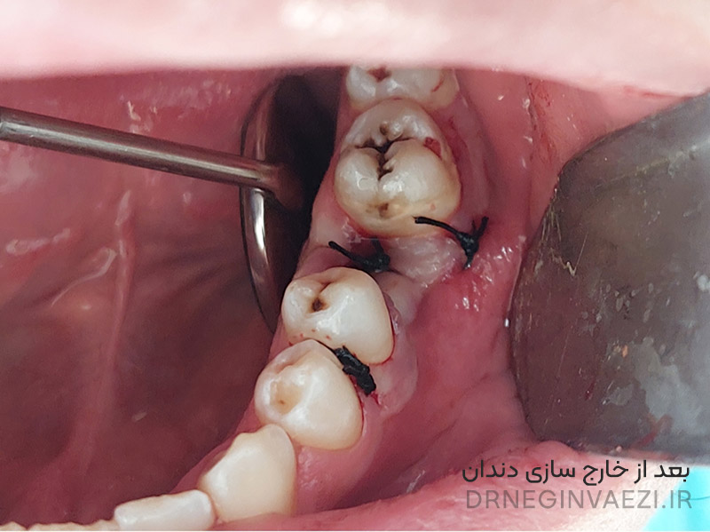 نمونه کار جراحی دندان خراب نمونه کار جراحی دندان در تبریز کشیدن دندان در تبریز