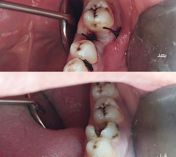 جراحی دندان عفونی در تبریز، خارج‌سازی دندان تخریب‌شده، درمان دندان عفونی، دندانپزشک متخصص جراحی تبریز، جراحی دندان