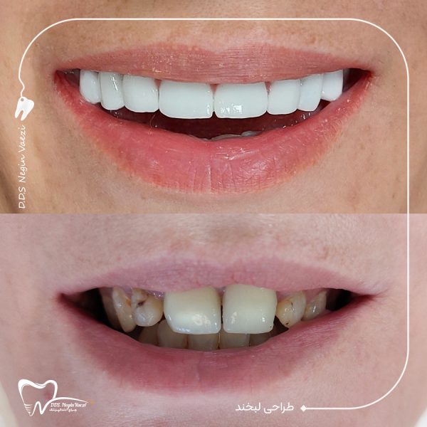 نمونه کار طراحی لبخند در تبریز با روکش‌ های تمام سرامیکی رنگ BW، اصلاح طرح لبخند و زیبایی دندان‌ ها