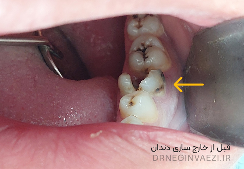 تصویر قبل از جراحی دندان عفونی و تخریب‌ شده