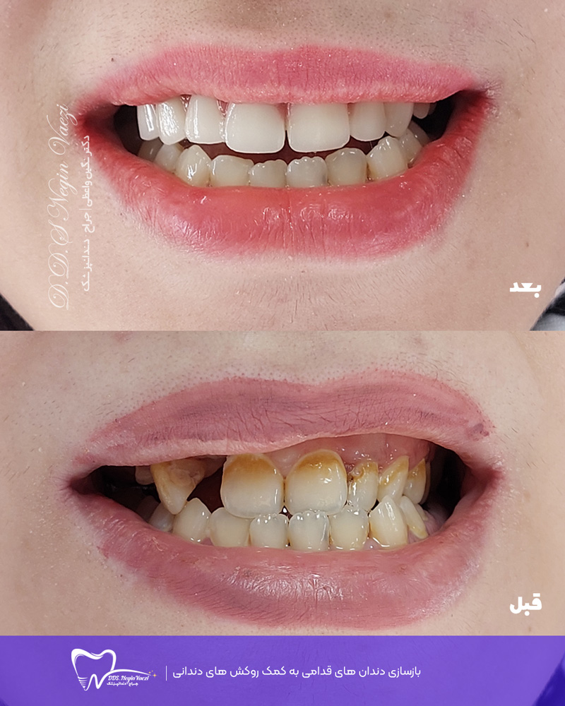 بازسازی دندان‌های قدامی با روکش دندانی در تبریز - طراحی لبخند زیبا و طبیعی با روکش‌های سرامیکی و زیرکونیا