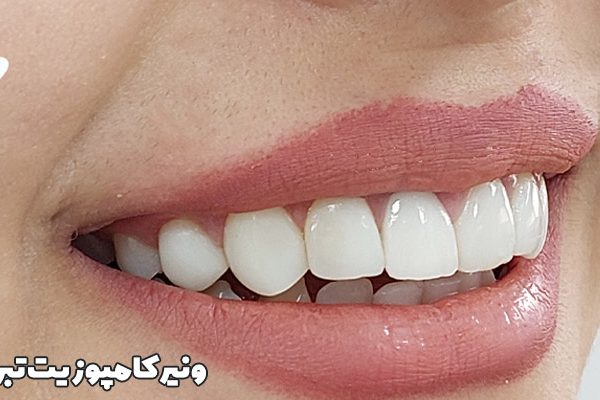 بهترین دندانپزشک ماپوزیت تبریز بهترین دندانپزشک ونیر تبریز بهترین دندانپزشک لمینیت در تبریز