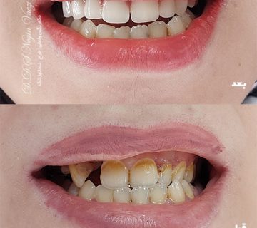 بازسازی دندان‌های قدامی با روکش دندانی در تبریز – ترمیم شکستگی و تغییر رنگ دندان با روکش‌های سرامیکی و زیرکونیا برای لبخندی زیبا و ماندگار.