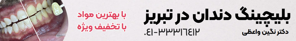 تبلیغ بلیچینگ دندان در تبریز