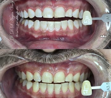 عکس قبل و بعد بلیچینگ دندان در تبریز