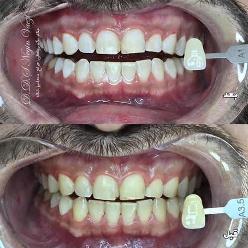 عکس قبل و بعد بلیچینگ دندان در تبریز