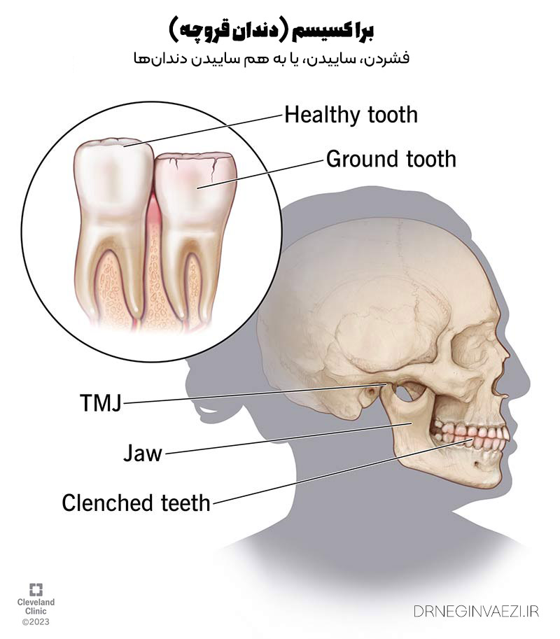 براکسیسم دندان قروچه چیست bRUXISM چیست