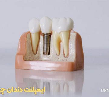 عکس ایمپلنت دندان قبل و بعد قیمت ایمپلنت دندان چیست عوارض ایمپلنت دندان چیست هزینه ایمپلنت دندان با بیمه فیلم ایمپلنت دندان ایمپلنت دندان قیمت 1404 ایمپلنت دندان درد دارد هزینه ایمپلنت دندان با بیمه تامین اجتماعی