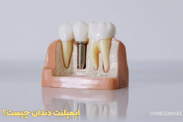 عکس ایمپلنت دندان قبل و بعد قیمت ایمپلنت دندان چیست عوارض ایمپلنت دندان چیست هزینه ایمپلنت دندان با بیمه فیلم ایمپلنت دندان ایمپلنت دندان قیمت 1404 ایمپلنت دندان درد دارد هزینه ایمپلنت دندان با بیمه تامین اجتماعی
