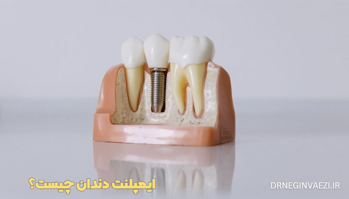 عکس ایمپلنت دندان قبل و بعد قیمت ایمپلنت دندان چیست عوارض ایمپلنت دندان چیست هزینه ایمپلنت دندان با بیمه فیلم ایمپلنت دندان ایمپلنت دندان قیمت 1404 ایمپلنت دندان درد دارد هزینه ایمپلنت دندان با بیمه تامین اجتماعی