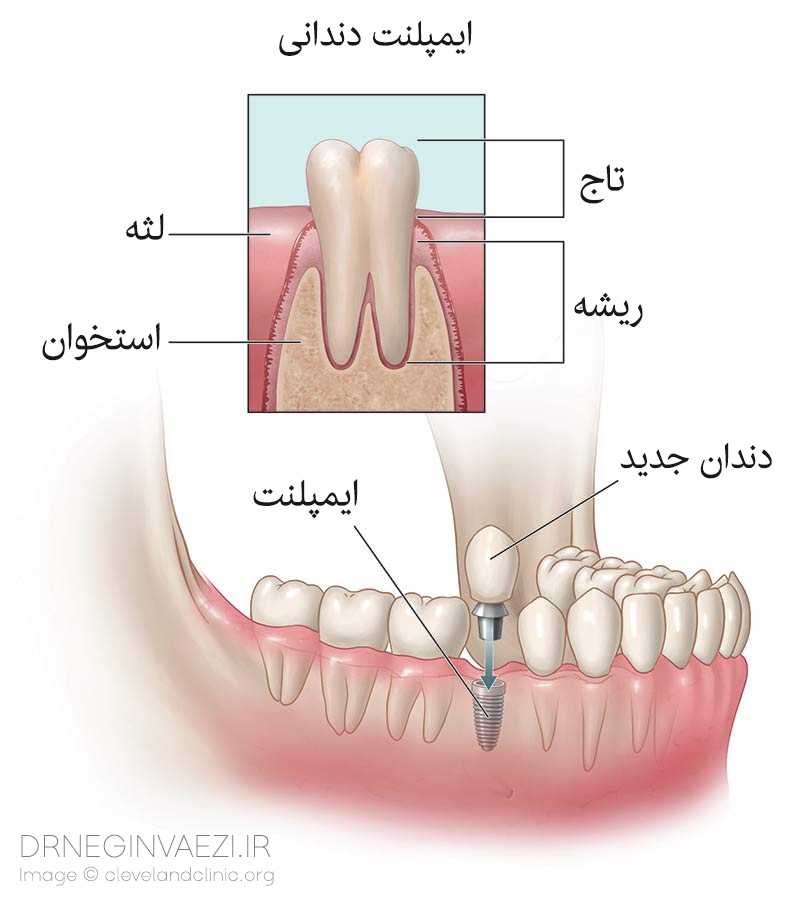 اییمپلنت دندانی چیست-ایمپلنت دندان در تبریز - قیمت ایمپلنت دندان - نحوه کاشت ایمپلنت دندان-مراحل کاشت ایمپلنت