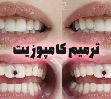 پرکردن دندان با کامپوزیت کامپوزیت دندان چیست؟ مزایا و معایب کامپوزیت دندان قیمت پرکردن دندان با کامپوزیت تفاوت آمالگام و کامپوزیت عمر پرکردگی کامپوزیت چقدر است؟ آیا کامپوزیت دندان ضرر دارد؟ مراحل پرکردن دندان با کامپوزیت هزینه کامپوزیت دندان 1404