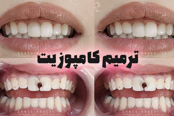 پرکردن دندان با کامپوزیت کامپوزیت دندان چیست؟ مزایا و معایب کامپوزیت دندان قیمت پرکردن دندان با کامپوزیت تفاوت آمالگام و کامپوزیت عمر پرکردگی کامپوزیت چقدر است؟ آیا کامپوزیت دندان ضرر دارد؟ مراحل پرکردن دندان با کامپوزیت هزینه کامپوزیت دندان 1404