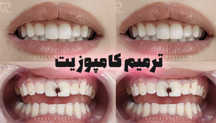 پرکردن دندان با کامپوزیت کامپوزیت دندان چیست؟ مزایا و معایب کامپوزیت دندان قیمت پرکردن دندان با کامپوزیت تفاوت آمالگام و کامپوزیت عمر پرکردگی کامپوزیت چقدر است؟ آیا کامپوزیت دندان ضرر دارد؟ مراحل پرکردن دندان با کامپوزیت هزینه کامپوزیت دندان 1404