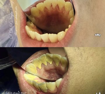 قبل و بعد جرم شدید دندان در بیمار - جرم گیری کامل در مطب تبریز توسط دکتر نگین واعظی - بهترین دکتر زیبایی در تبریز