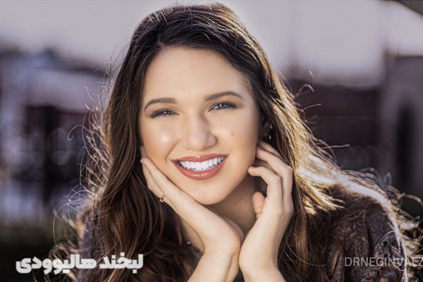 لبخند هالیوودی چیست - قیمت لبخند هالیوودی - لبخند هالیوودی تبریز ولیعصر - طراحی لبخند هالیوودی