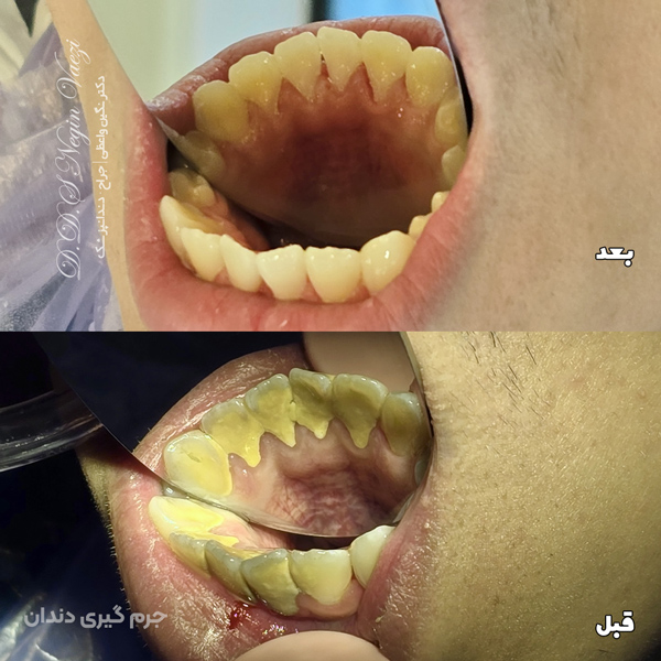 نمونه کار جرم گیری در تبریز - جرم گیری ارزان در تبریز - هزینه جرم گیری در تبریز - قبل و بع د از جرم گیری - آسیب جرم گیری به دندان؟