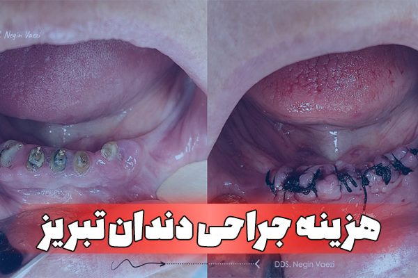 هزینه جراحی دندان در تبریز 1404 قیمت کشیدن دندان عقل تبریز بهترین جراح دندان تبریز هزینه ایمپلنت در تبریز جراحی لثه با لیزر تبریز دکتر نگین واعظی جراح دندان