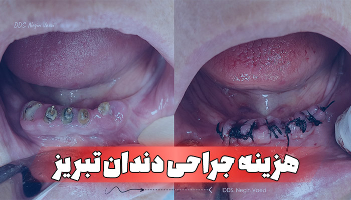 هزینه جراحی دندان در تبریز 1404 قیمت کشیدن دندان عقل تبریز بهترین جراح دندان تبریز هزینه ایمپلنت در تبریز جراحی لثه با لیزر تبریز دکتر نگین واعظی جراح دندان