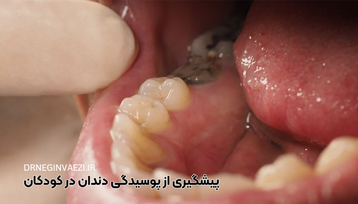 پیشگیری از پوسیدگی دندان در کودکان - دکتر واعظی دندانپزشک کودک تبریز ولیعصر